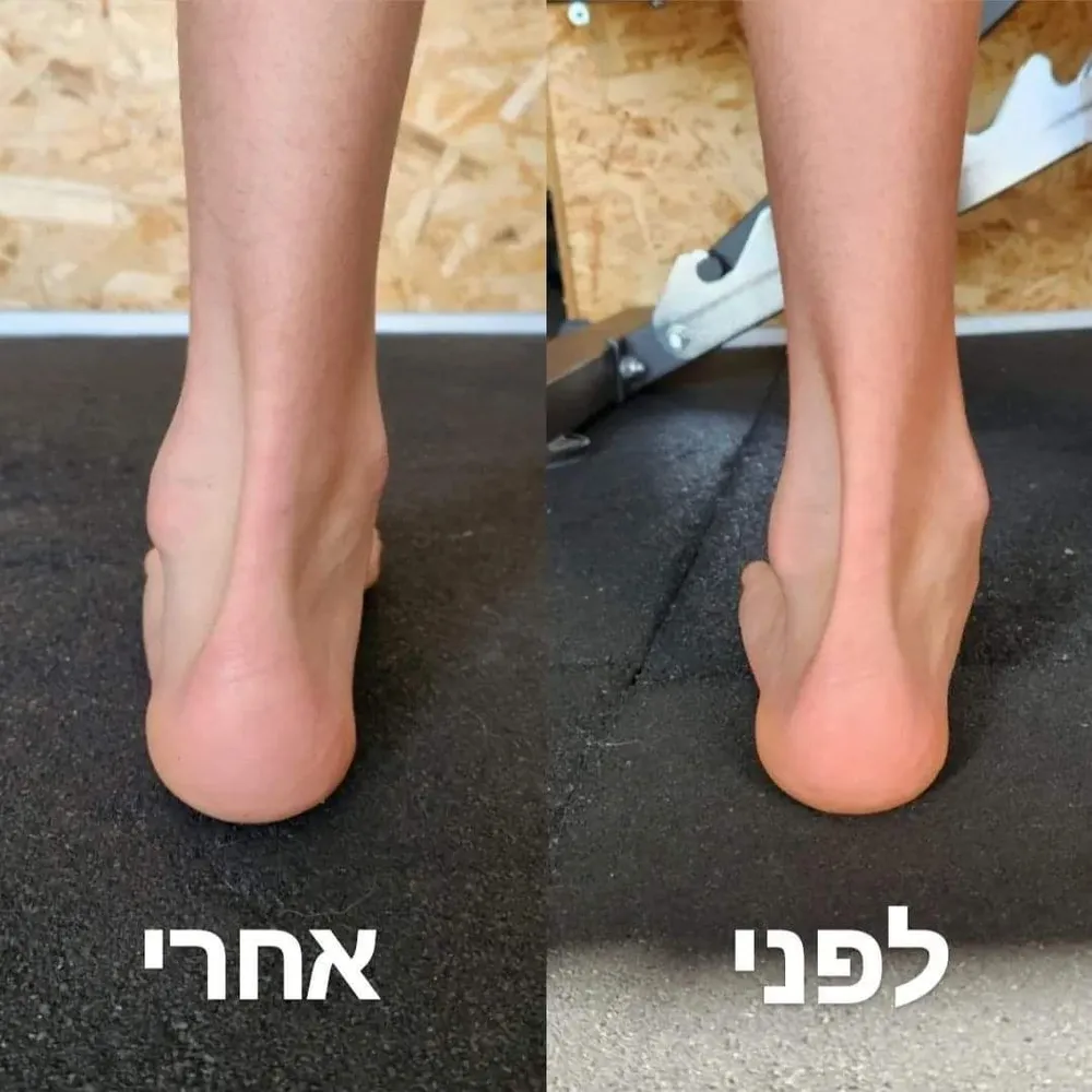 כף רגל שטוחה, לפני ואחרי טיפול תנועתי אצל ניקיטה חומנקו